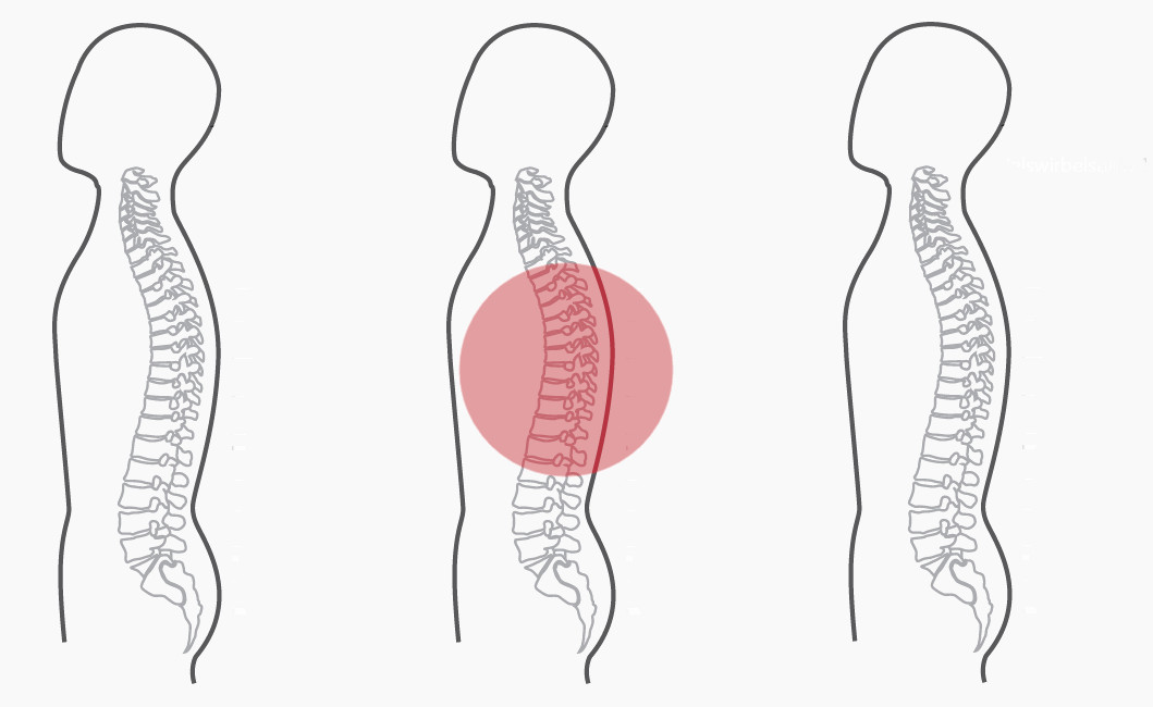 Grafik für das zweite empfohlene CERAGEM Programm der Master V4 Liege, bei Schmerzen im mittleren Rücken. Die Silhouette eines Mannes ist zu sehen. Die Intensität der roten Farbkreise stellt den Fokus der Massage dar. Brustwirbelsäule: Stark.