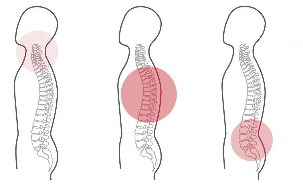 Grafik für das dritte empfohlene CERAGEM Programm der Master V3 Liege, bei Schmerzen im oberen Rücken. Die Silhouette eines Mannes ist zu sehen. Die Intensität der roten Farbkreise stellt den Fokus der Massage dar. Brustwirbelsäule: Stark. Unterer Rücken: Mittel.