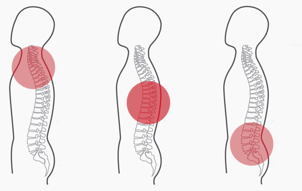 Grafik für das CERAGEM Programm Nummer 1 (Spezialprogramm) der Master V4 Liege. Die Intensität der roten Farbkreise stellt den Fokus der Massage dar. Halswirbelsäule und oberer Rücken: Stark. Brustwirbelsäule: Sehr stark. Unterer Rücken: Stark.