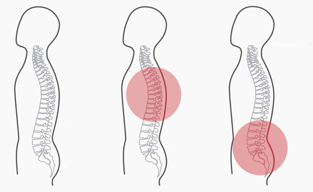 Grafik für das zweite empfohlene CERAGEM Programm der Master V4 Liege, bei Schmerzen im unteren Rücken. Die Silhouette eines Mannes ist zu sehen. Die Intensität der roten Farbkreise stellt den Fokus der Massage dar. Brustwirbelsäule: Stark. Unterer Rücken: Stark.