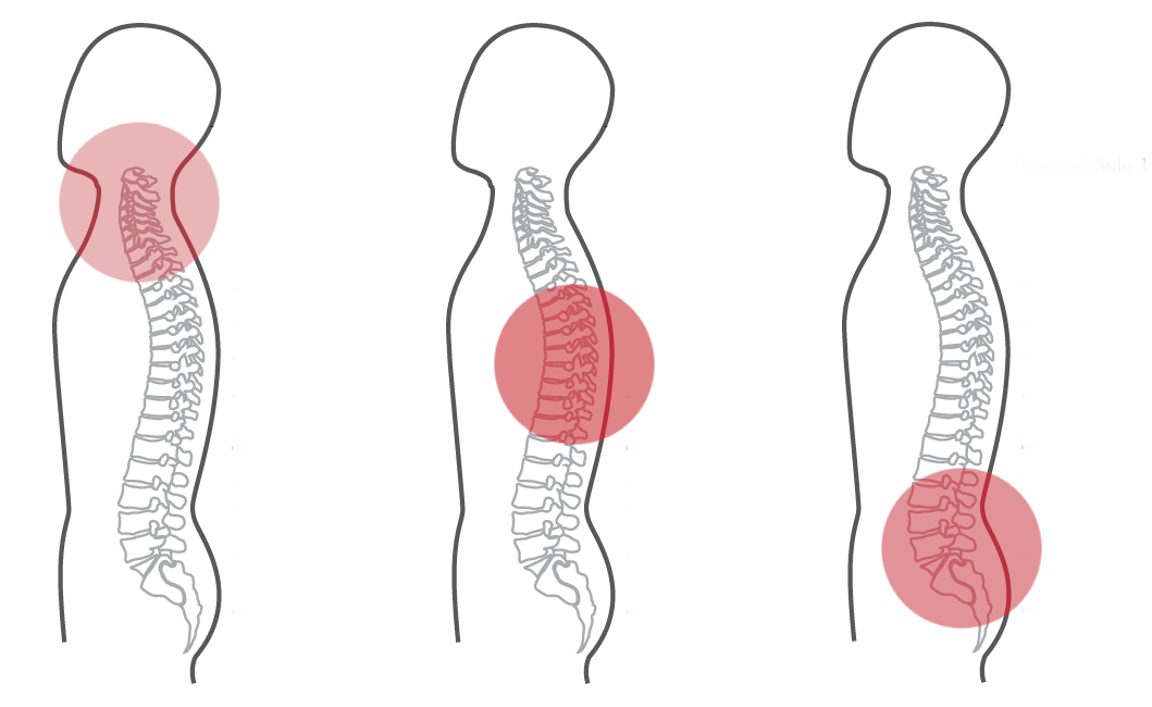 Grafik für das erste empfohlene CERAGEM Programm der Master V4 Liege, bei Schmerzen im oberen Rücken, mittleren und ganzen Rücken. Die Silhouette eines Mannes ist zu sehen. Die Intensität der roten Farbkreise stellt den Fokus der Massage dar. Halswirbelsäule: Stark. Brustwirbelsäule: Stark. Unterer Rücken: Stark.