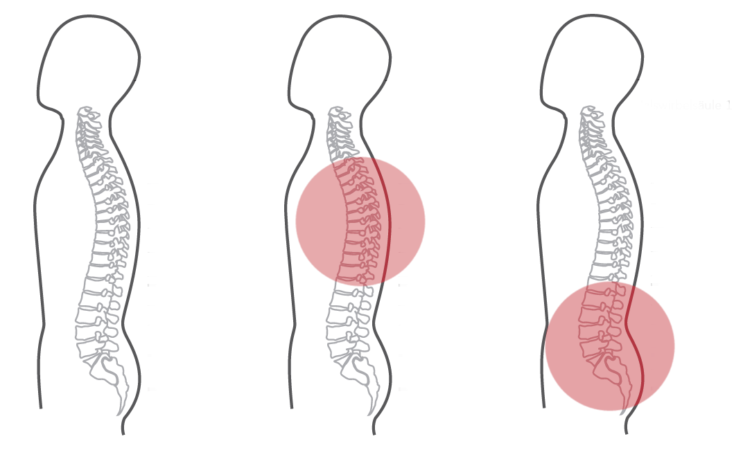 Grafik zum Programm Nummer 6 der CERAGEM Master V4 Liege. Die Intensität der roten Farbkreise stellt den Fokus der Massage dar. Brustwirbelsäule: Stark. Unterer Rücken: Stark.